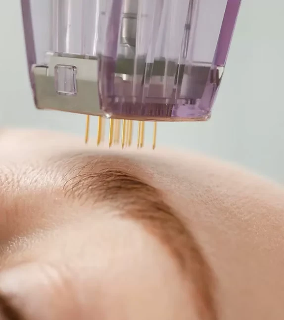 Morpheus8 skin tightening treatment